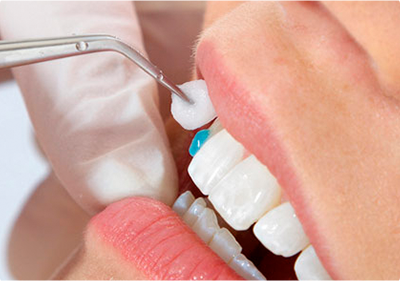 Технология установки виниров на зубы