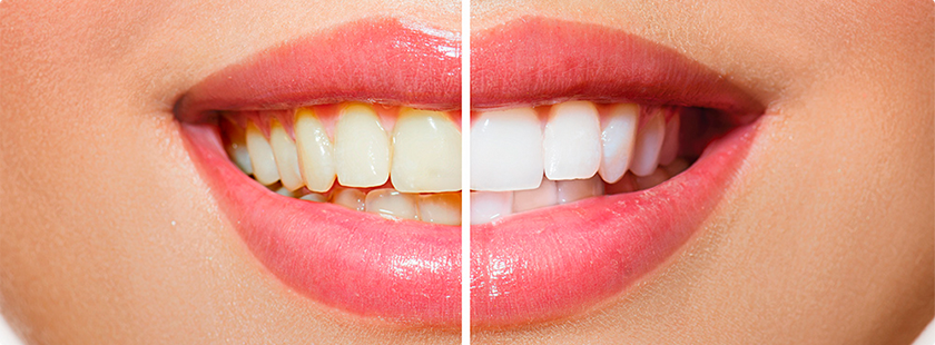 Естественный цвет зубов