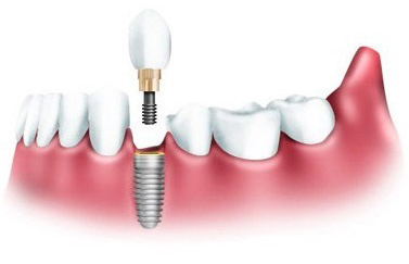 Что такое имплантация зубов?