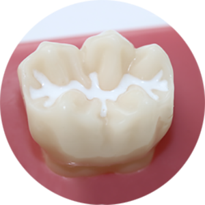 Герметизация фиссур – защитный барьер зубной эмали