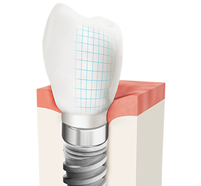 Имплантация зубов - установка зубного протеза на место утерянного зуба.