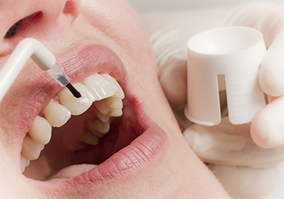 Фторирование зубов детям — эффективная мера профилактики кариеса.