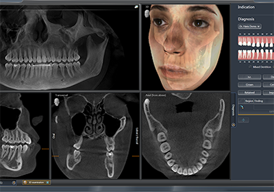 Панорамный снимок зубов проводится при помощи ортопантомографа.