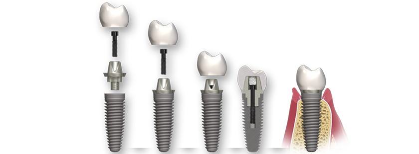 Отличия двухэтапной имплантации зубов