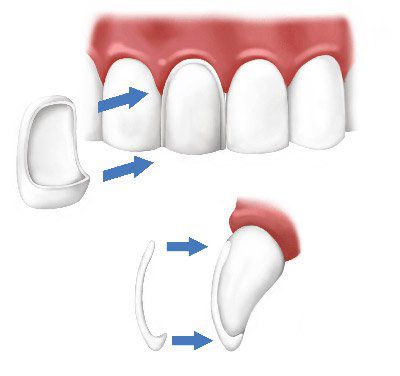 Для восстановления зубов эстетическая стоматология