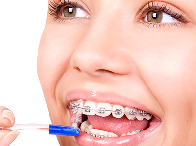 Что нужно знать о чистке зубов с брекетами