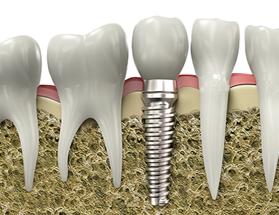 Зубные имплантаты — лучший вариант протезирования