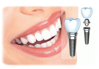 Восстановление зубов с помощью имплантов