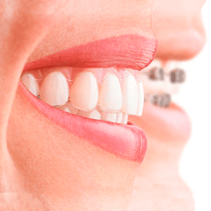 Ортодонтия: что это за наука